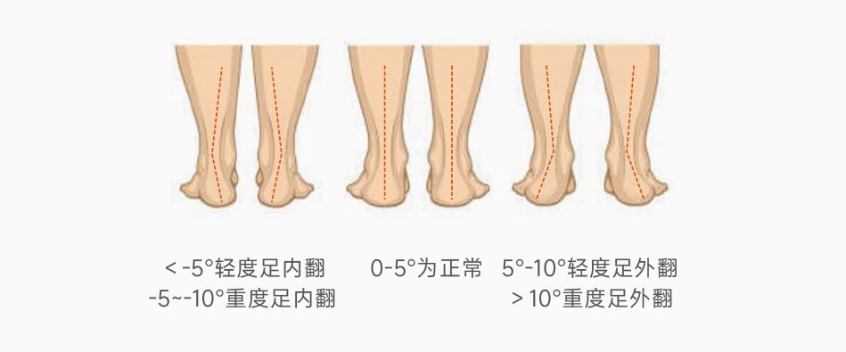 跟骨力线参考范围